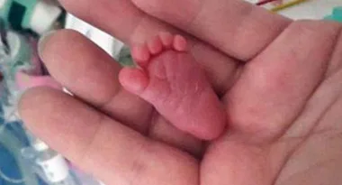 World’s Tiniest Baby Is now 9-Months-Old And Getting Stronger Every Day