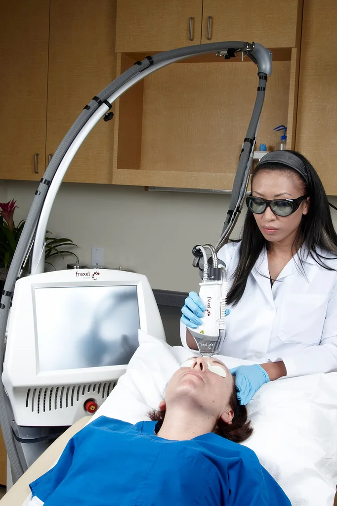 Fraxel laser treatment