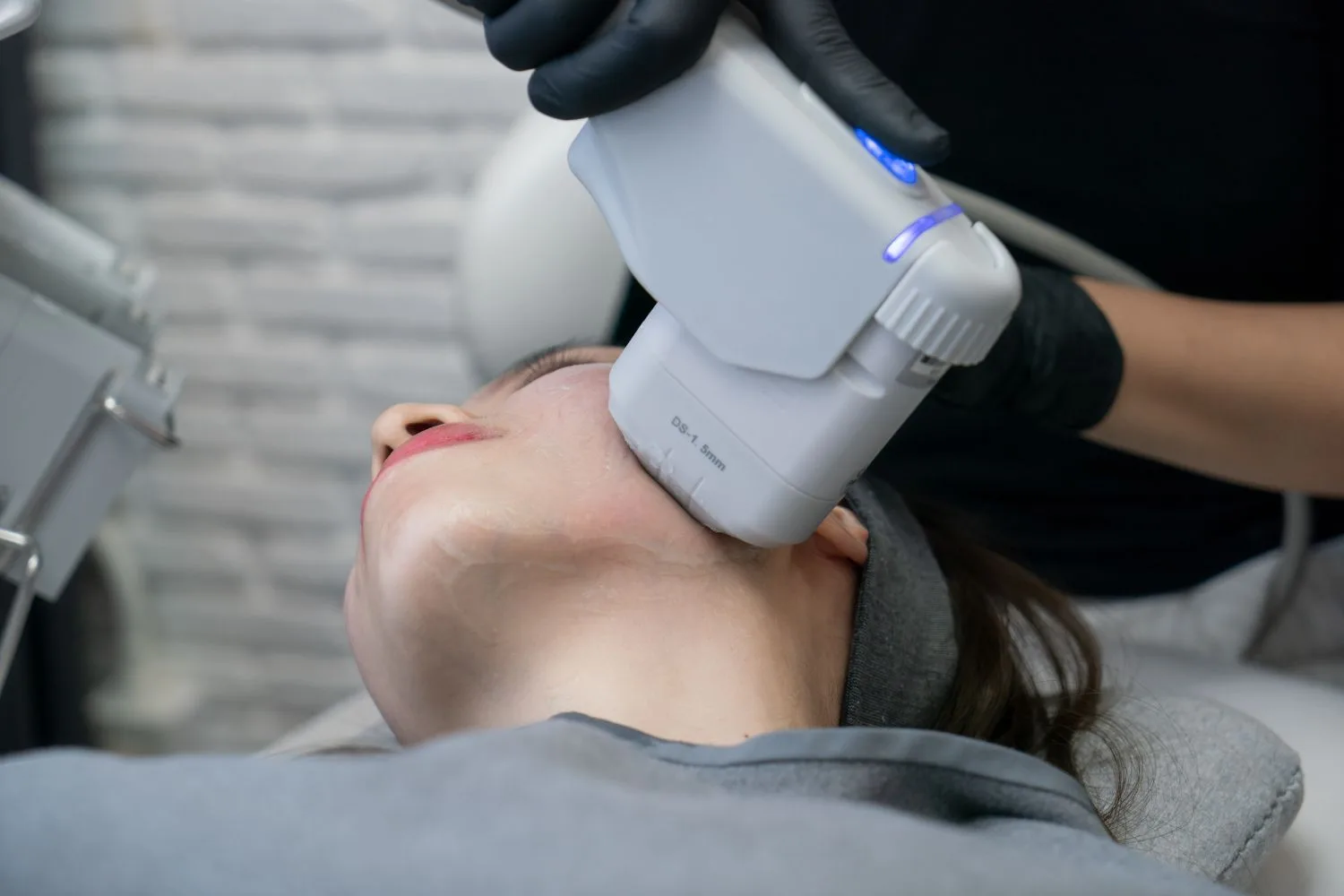 hifu-treatment
