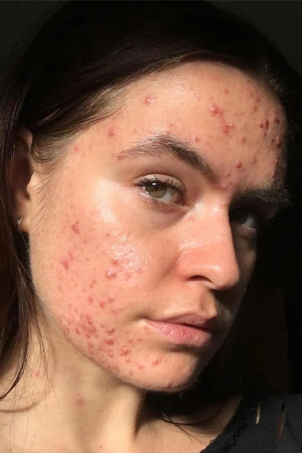 It takes time for pimple treatments to work.