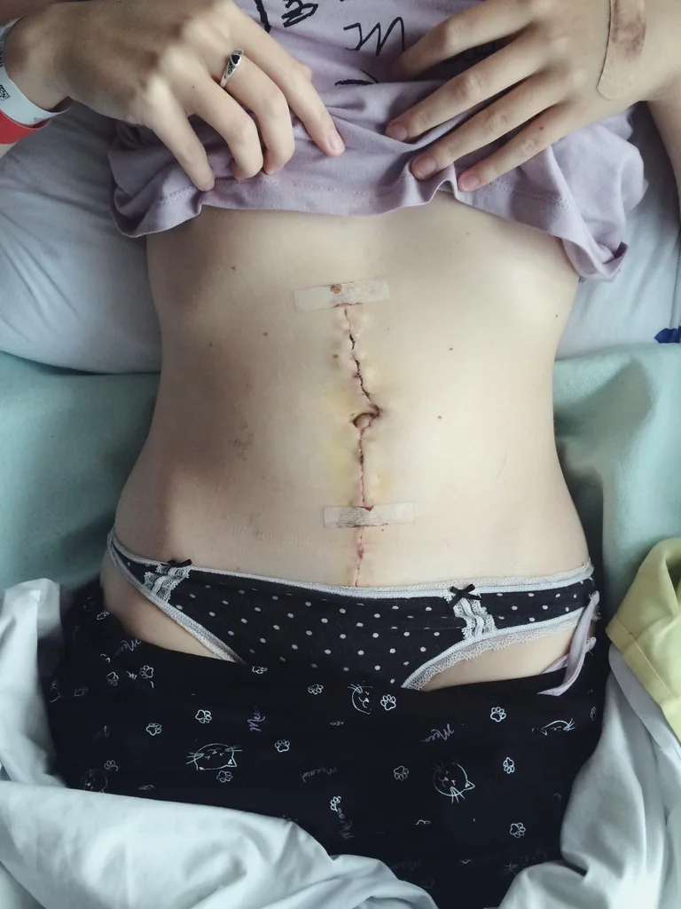 Ovarian Cancer Scar