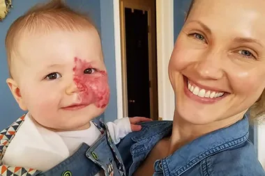 Mum Pens Powerful Post After Baby Born With Port-Wine Stain