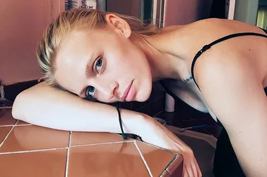 Model Opens Up About Losing Her Leg To Toxic Shock Syndrome