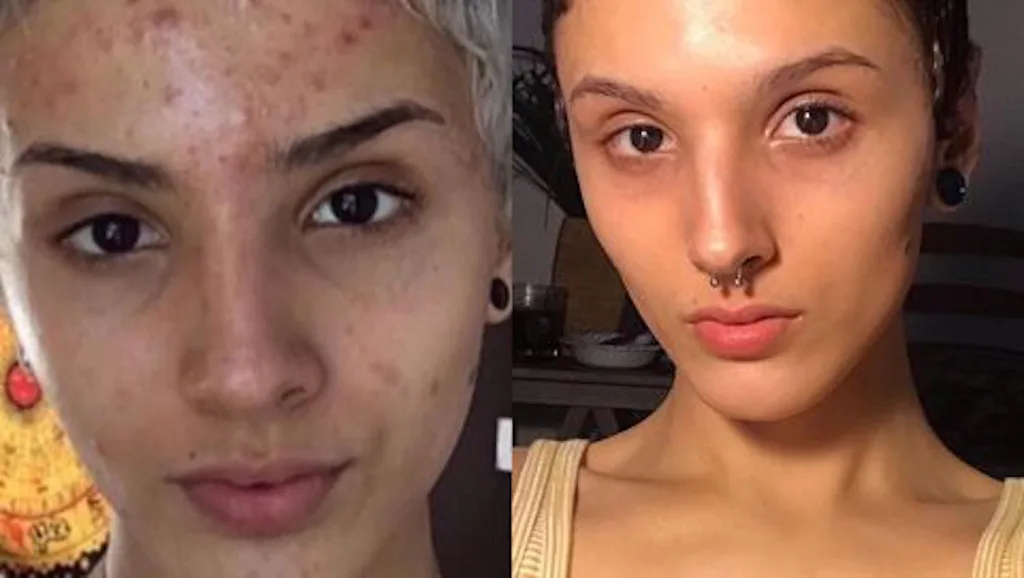 Acne Before and After