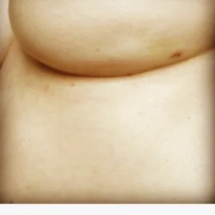 Close-up selfie of a person's bare midsection and chest, with a skin blemish on the right side.