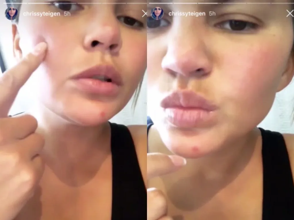 Chrissy Teigen showing her acne on Instagram