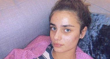 14 Celebrities Who’ve Shared Photos Of Their Acne