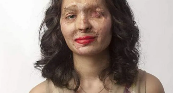 A woman with burn scars on her face, wearing red lipstick, with dark curly hair against a plain background.