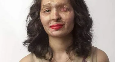 A woman with burn scars on her face, wearing red lipstick, with dark curly hair against a plain background.