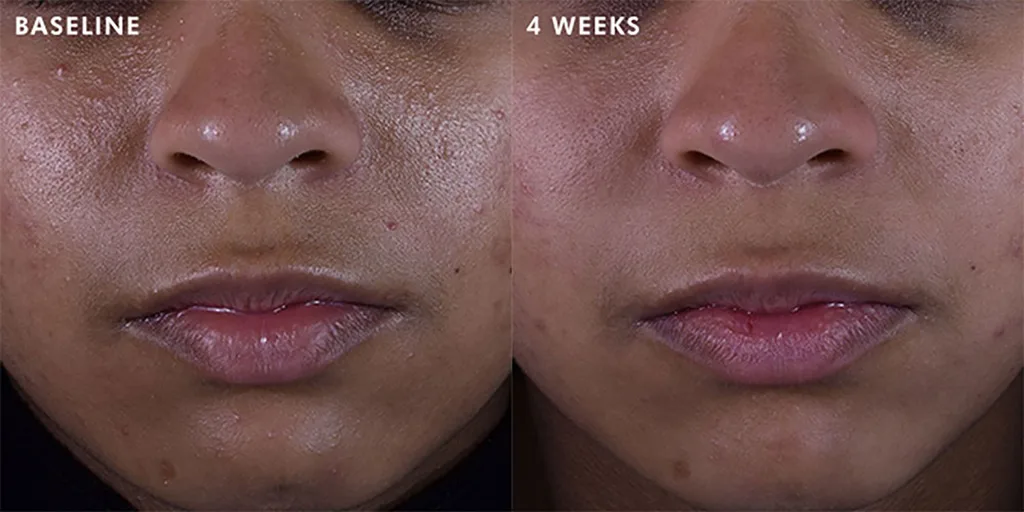 SkinCeuticals Silymarin CF Vitamin C serum before and after