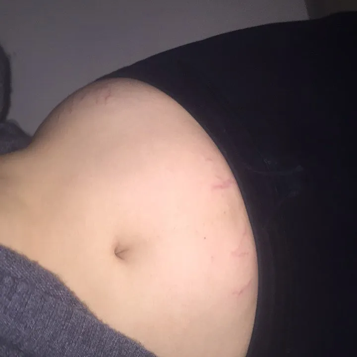 stretch marks