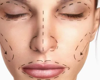 Close-up of a woman's face with dotted lines indicating cosmetic surgery or procedures on her nose and face.