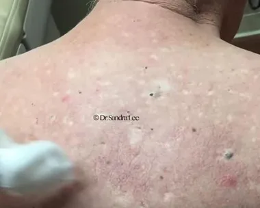 This has to be Dr Pimple Popper’s most epic blackhead video ever