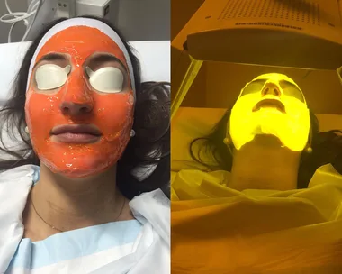 "Person undergoing Kleresca acne treatment, with orange gel mask and under yellow light therapy."