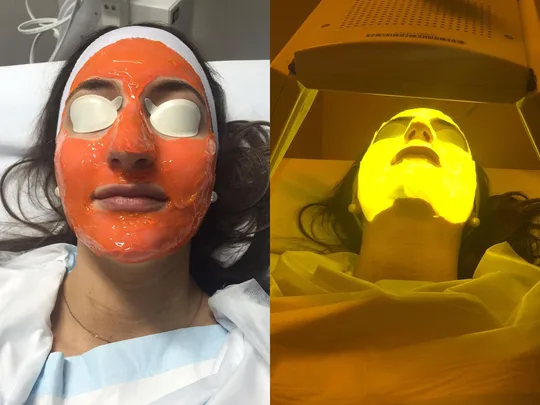 "Person undergoing Kleresca acne treatment, with orange gel mask and under yellow light therapy."