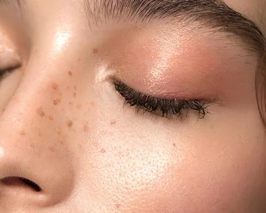 Close-up of a woman's closed eye and cheek, showing skin pigmentation and freckles.