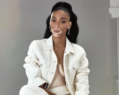 Winnie Harlow. 