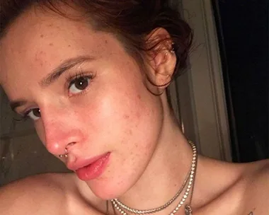 This Viral TikTok Is Making A Case For Clearing Acne With Nothing But Salt Water