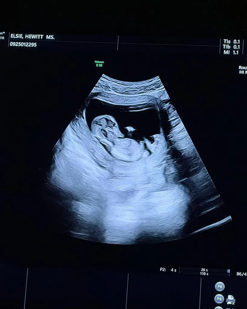 Pete Davidson and Elsie Hewitt's ultrasound