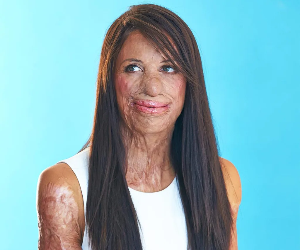 Turia Pitt