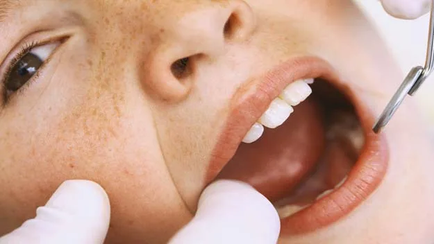 Child's teeth being examined by a dentist using a dental mirror, highlighting oral health care.