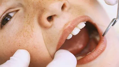 Child's teeth being examined by a dentist using a dental mirror, highlighting oral health care.