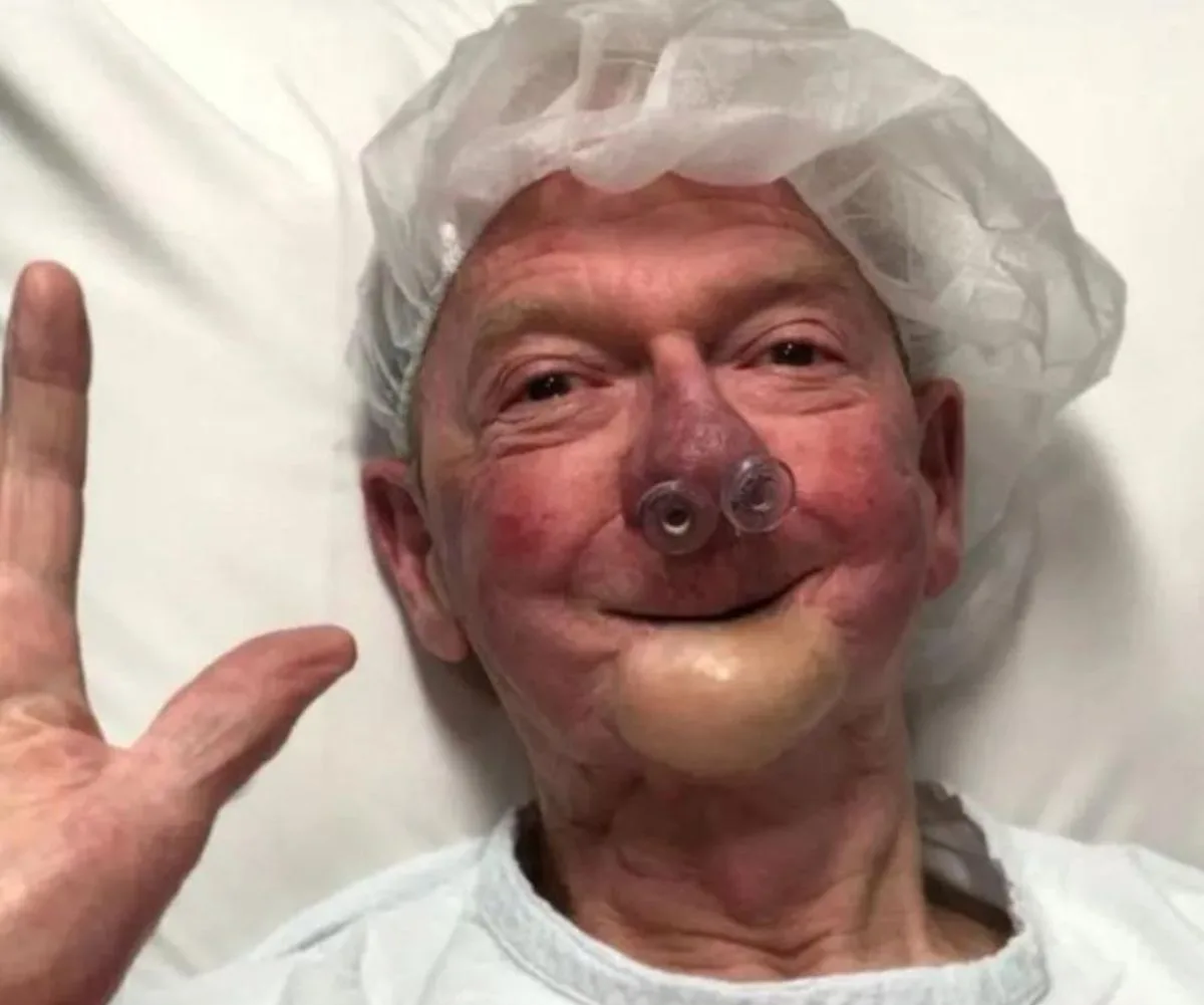 John Blackman smiles after surgery to remove cancer from his jaw. His face is swollen and he wears nose plugs