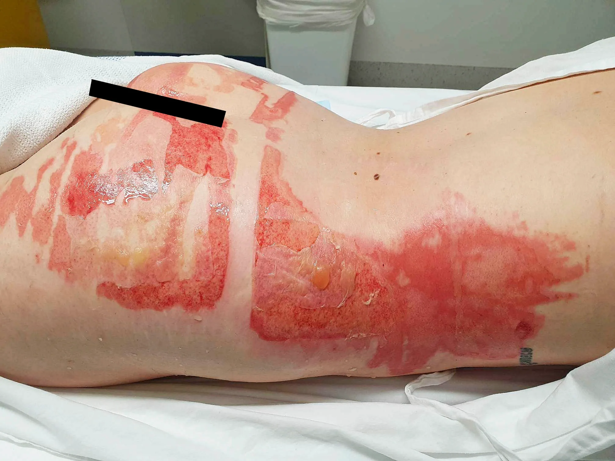 Second and third degree burns covered Steph Campbell's body.