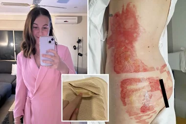 Steph Campbell speaks about how she was left with severe burns to her body after a hot water bottle started leaking.