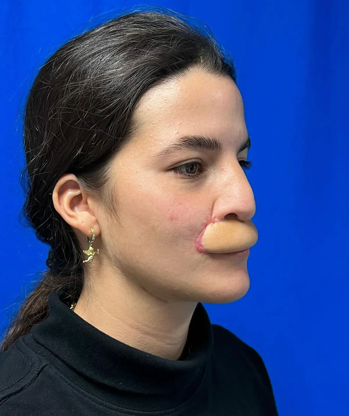 During the lip reconstruction process. (Image: Supplied)