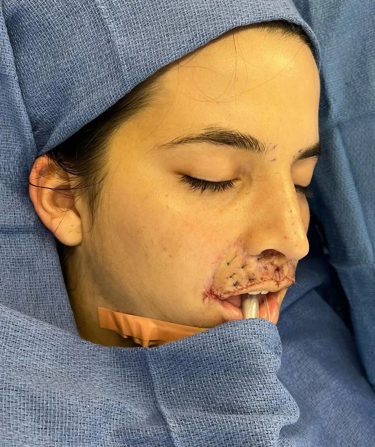 In hospital after a lip surgery. (Image: Supplied)