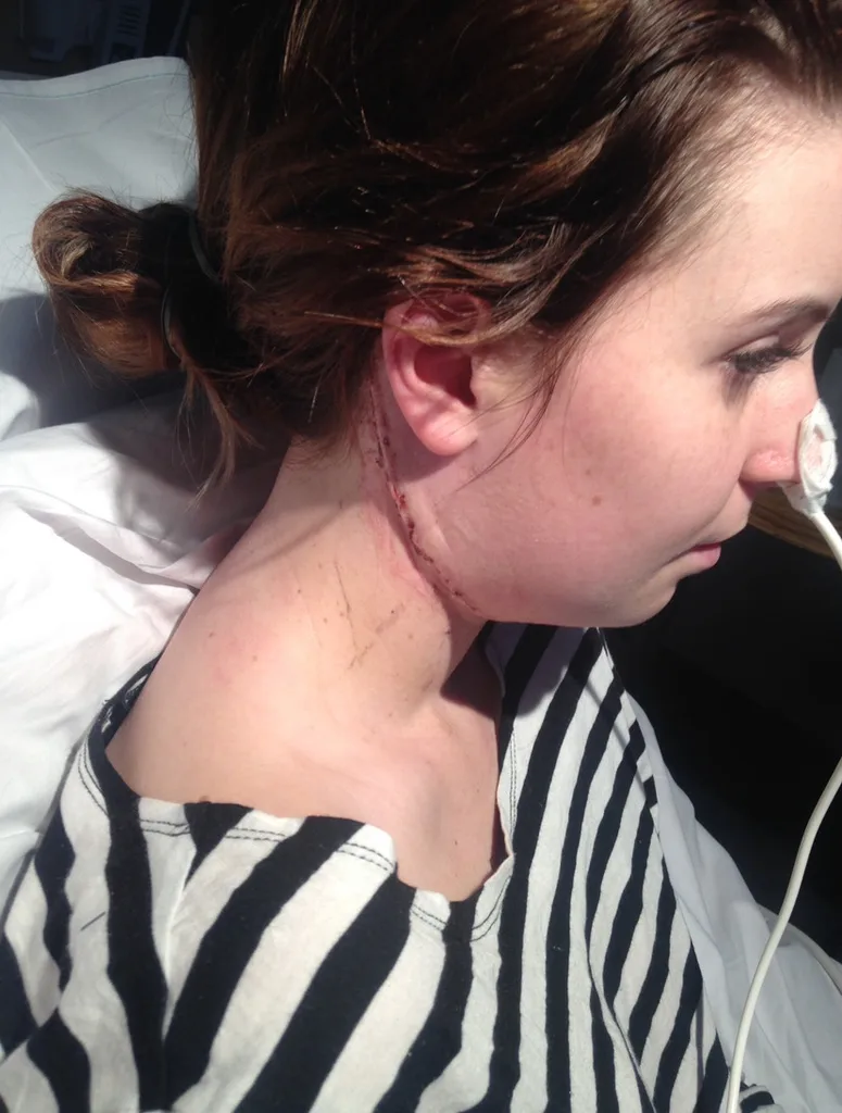 Bella wearing white and black top with big scar of her neck following surgery