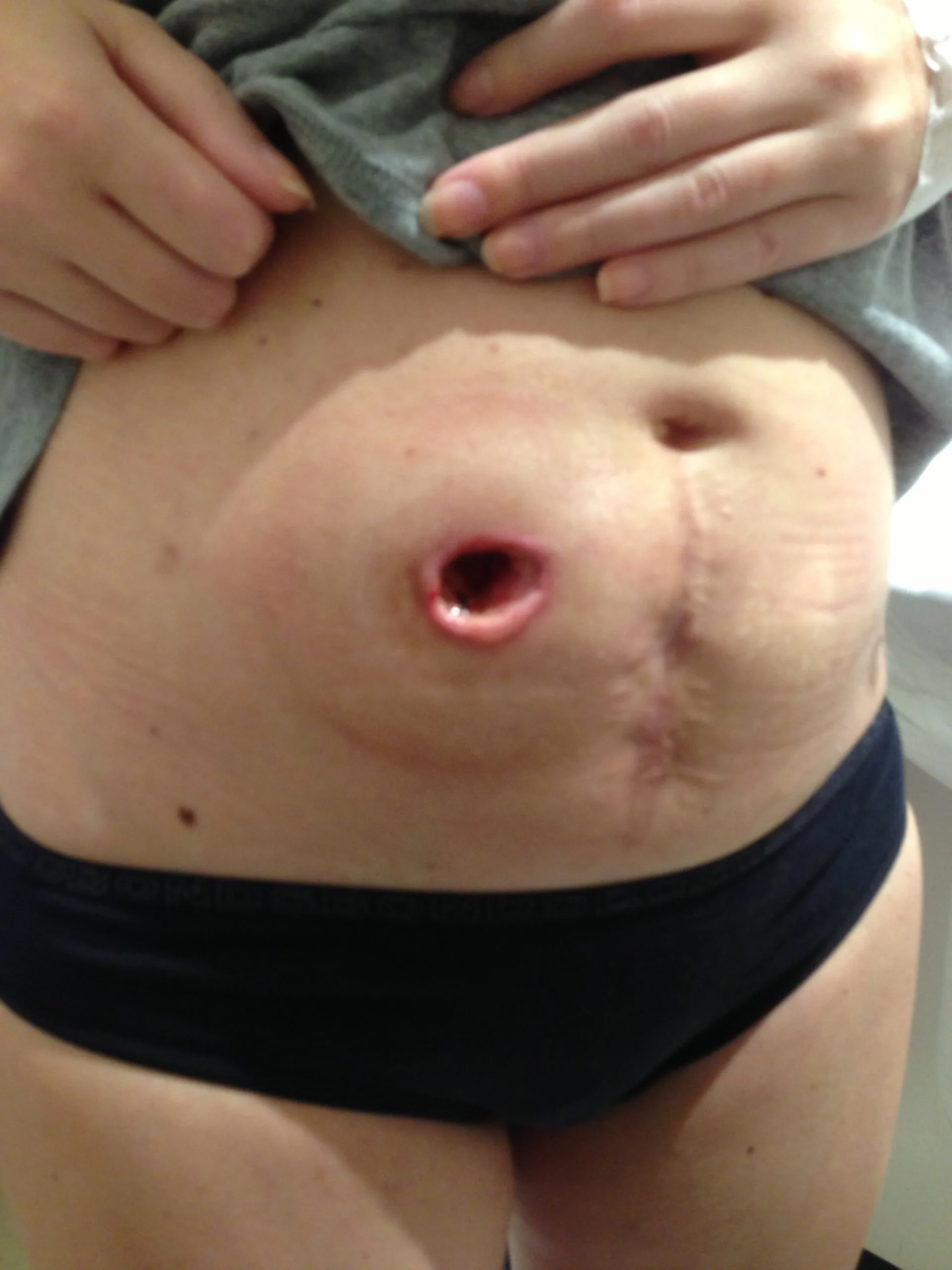 Jade's stomach exposing the hole left after her stoma bag was removed