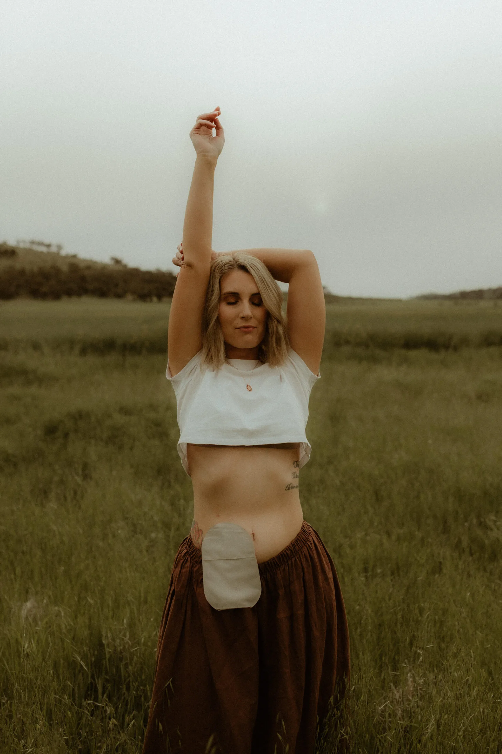 Rhiannon standing in a field wearing a crop top to expose her stoma bag