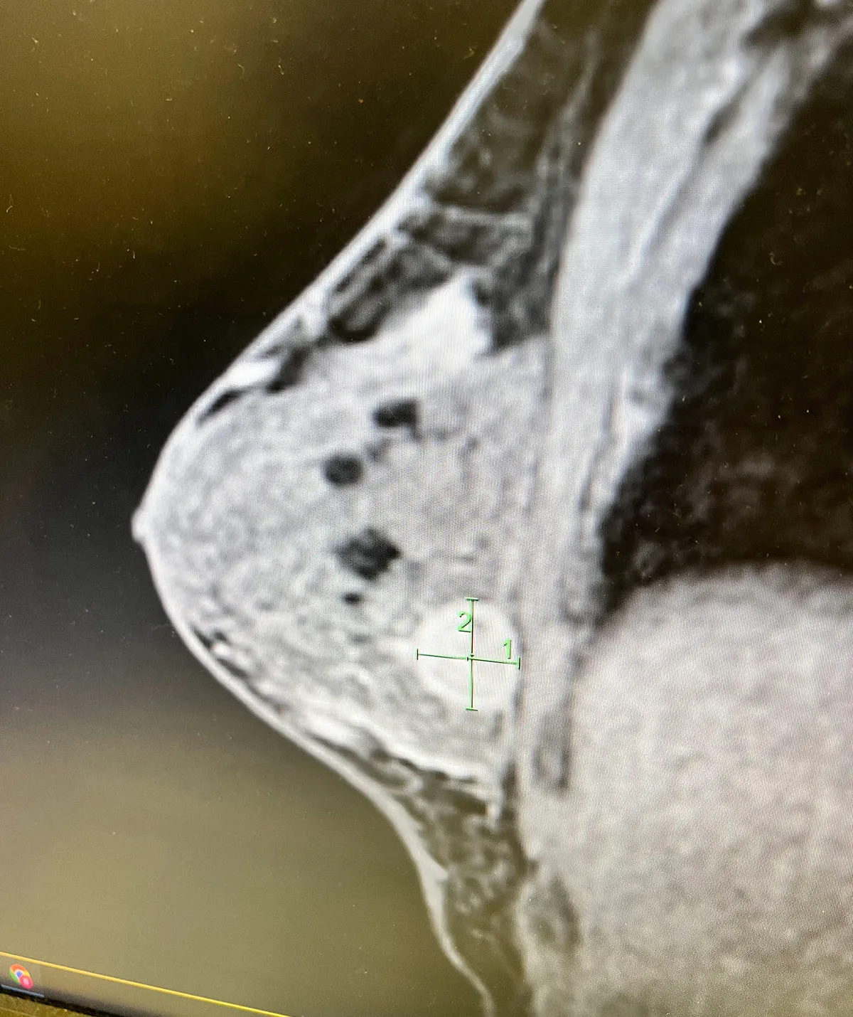 The MRI showing the cancerous lump in my right breast. (Image: Supplied)