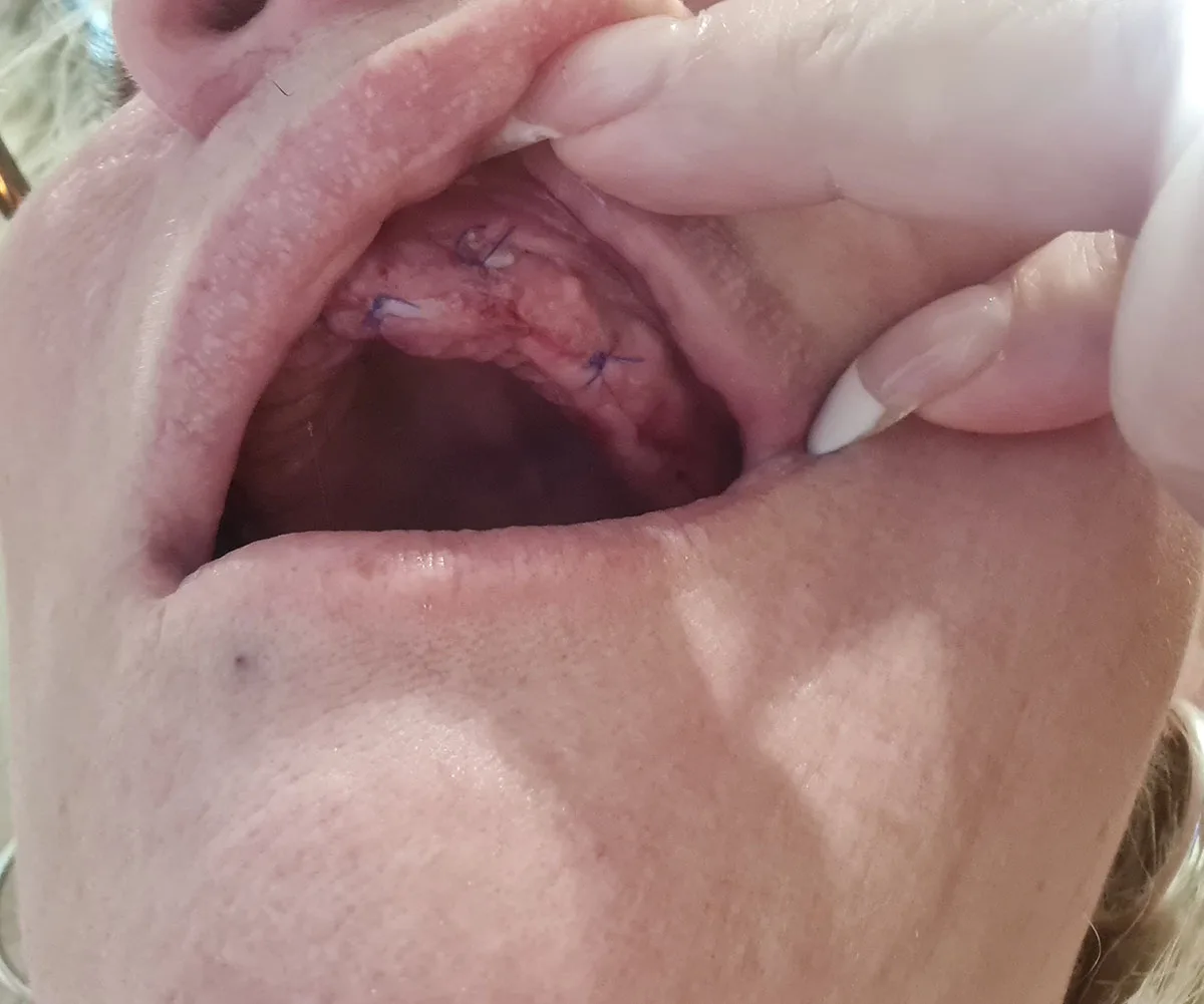 My mouth one day after surgery. (Image: Supplied)