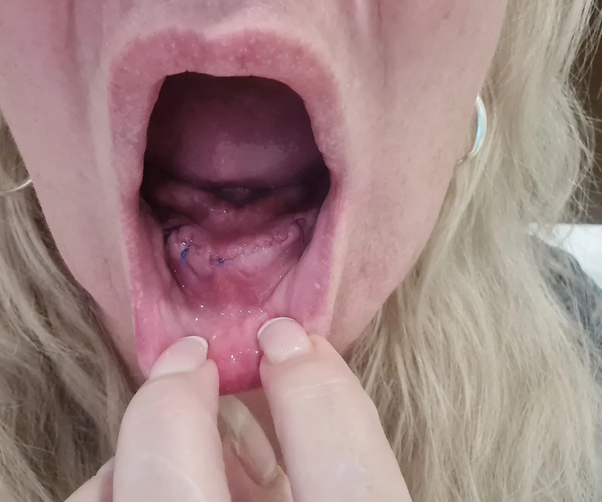 My mouth one day after surgery. (Image: Supplied)