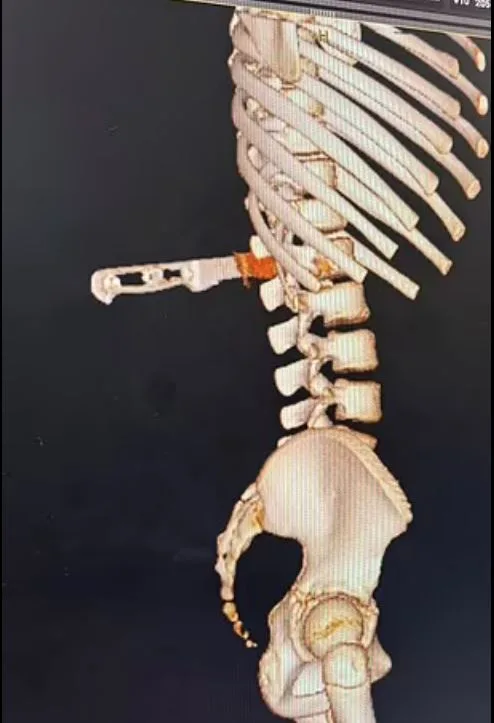 X-rays revealed the knife was lodged between the vertebrae of Landen's back