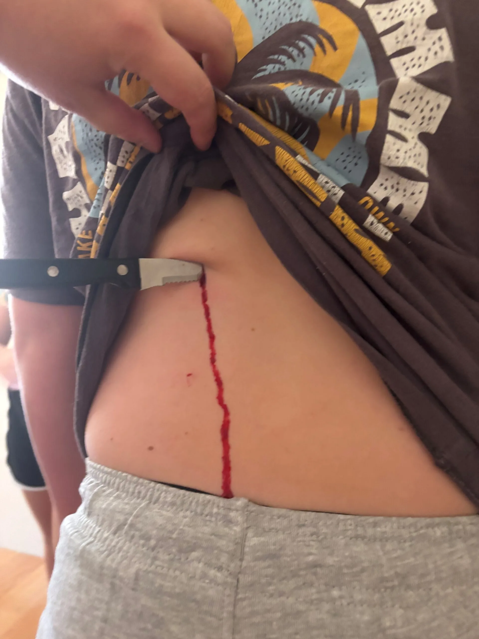 Despite falling onto an upturned steak knife, Landen's knife injury hardly bled