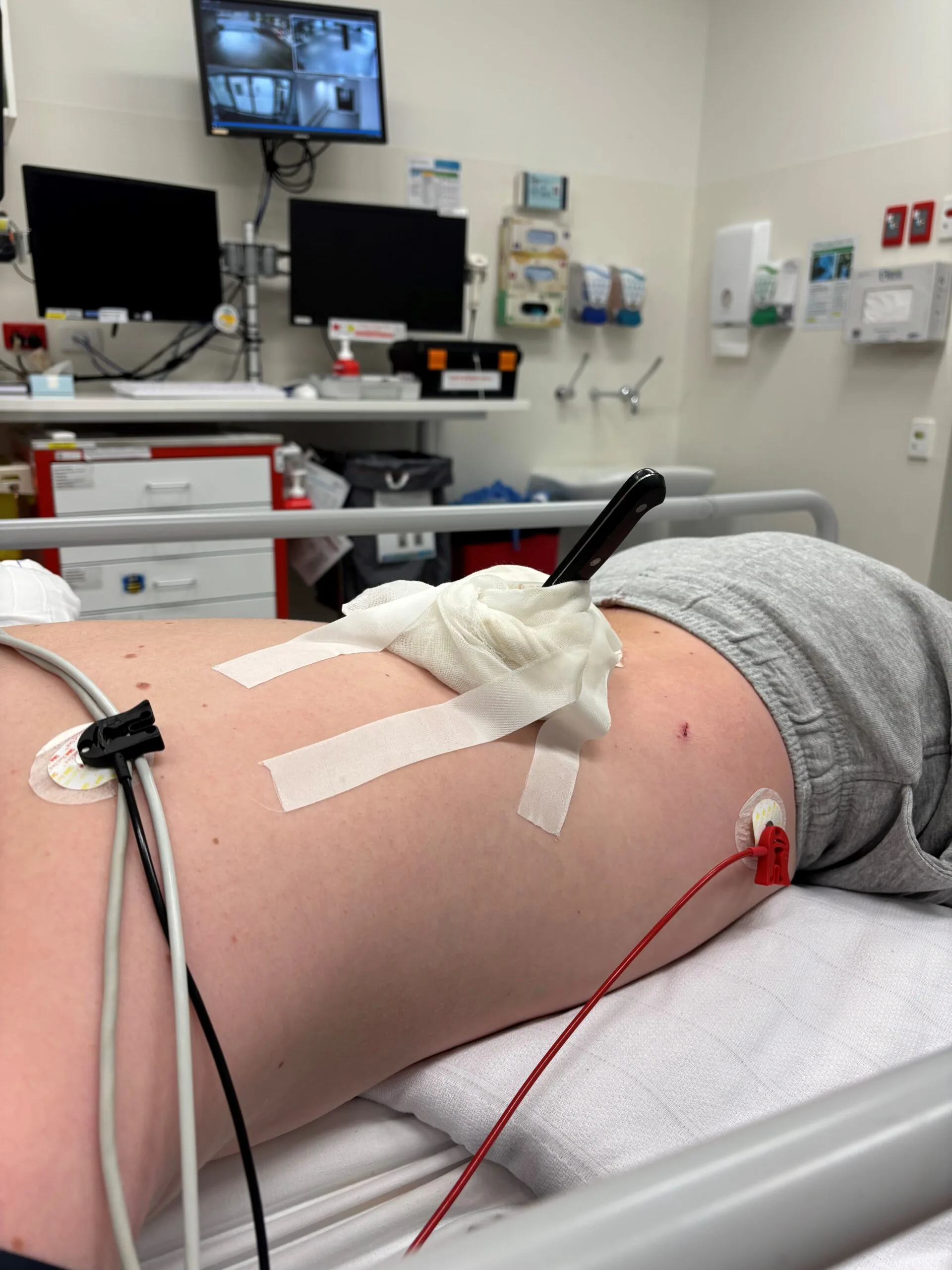 At the hospital, doctors broke the news the knife was only millimetres from Landen's spinal cord.