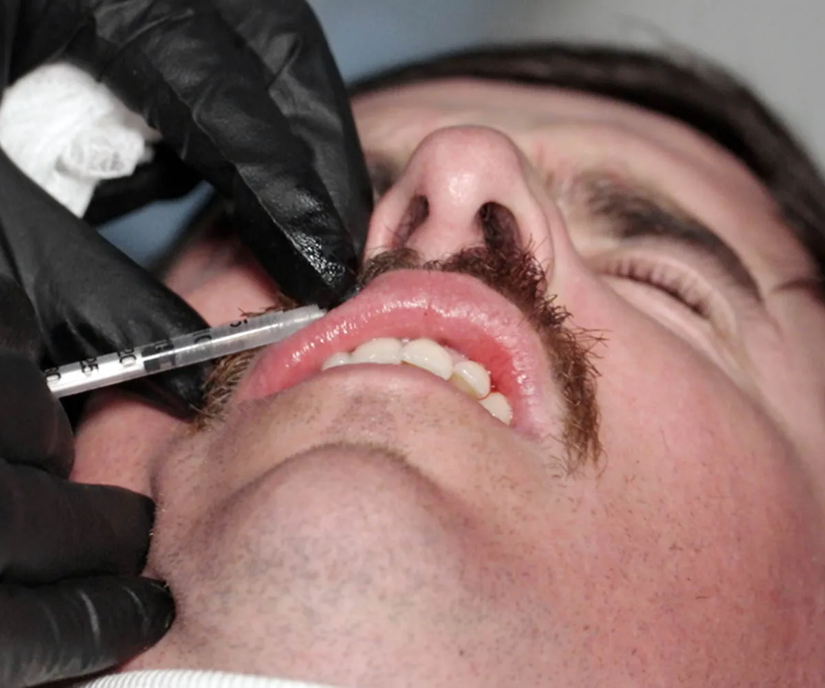 A hand wearing a black glove is pictured injecting a needle into Dom's lip