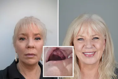 Renee Beal before and after dental treatment.
