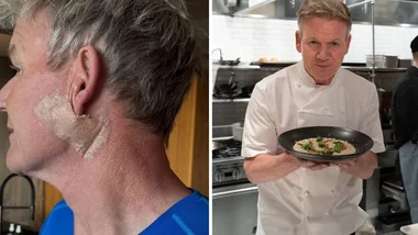 Gordon Ramsay reveals skin cancer diagnosis