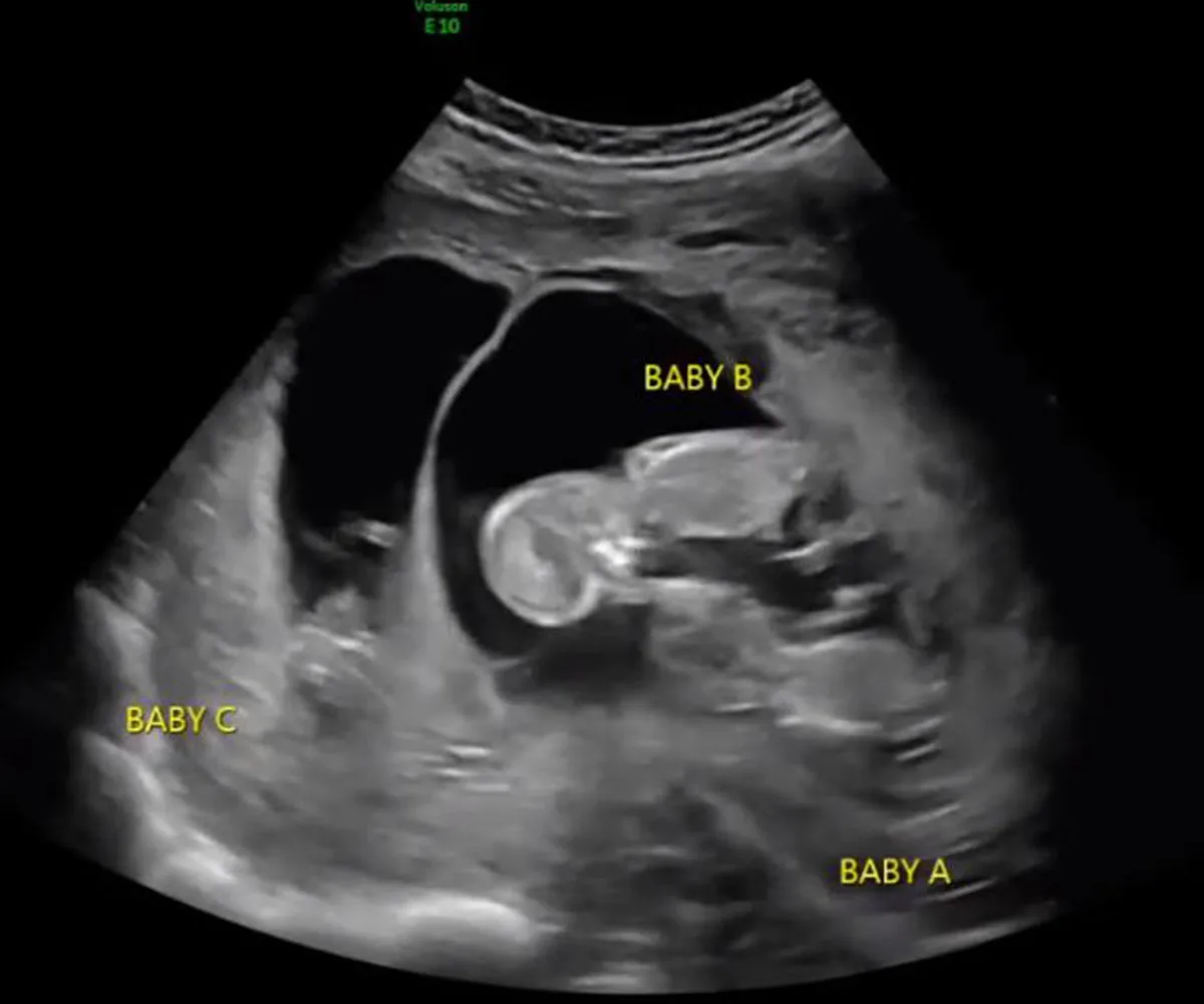 The ultra-sound showing triplets. (Image: Supplied)