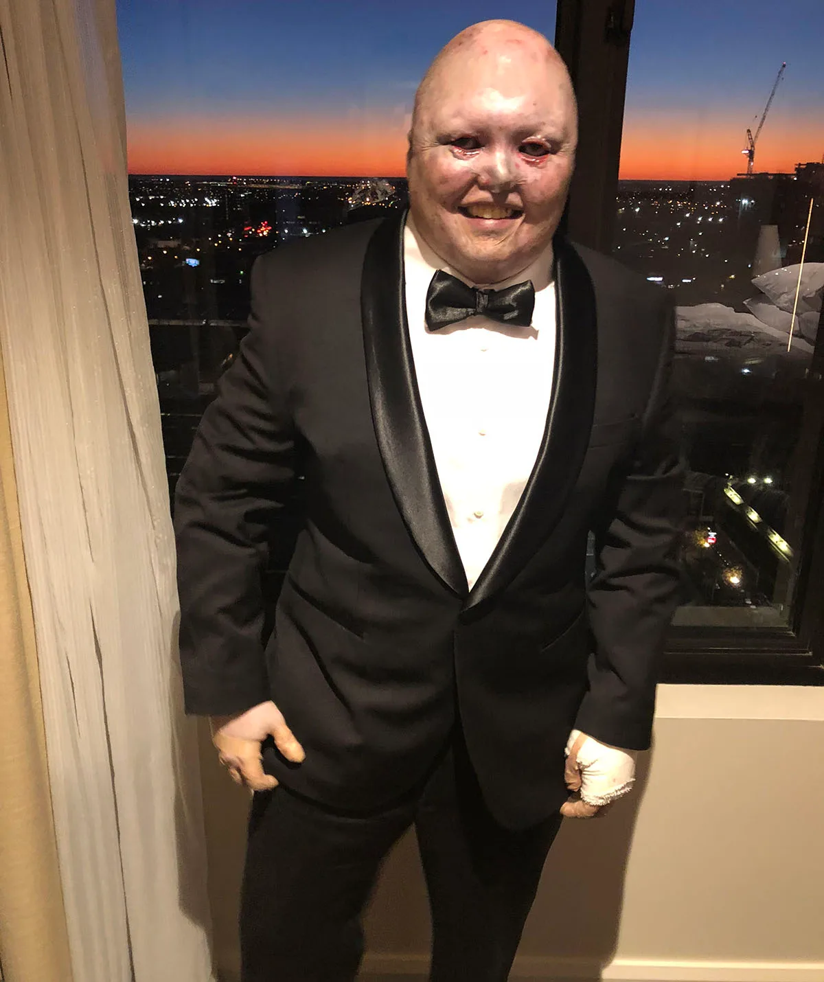 I have refused to let a rare skin condition hold me back from living my life. (Image: Supplied)