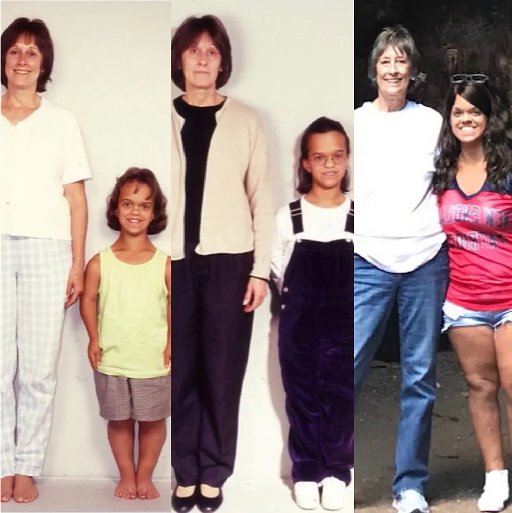 Me and mum before and after the limb lengthening. (Image: Supplied)