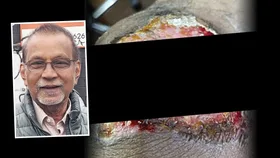 WARNING! My home remedy burnt my skin off!