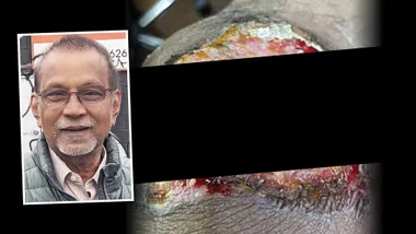 WARNING! My home remedy burnt my skin off!