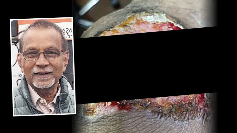 WARNING! My home remedy burnt my skin off!