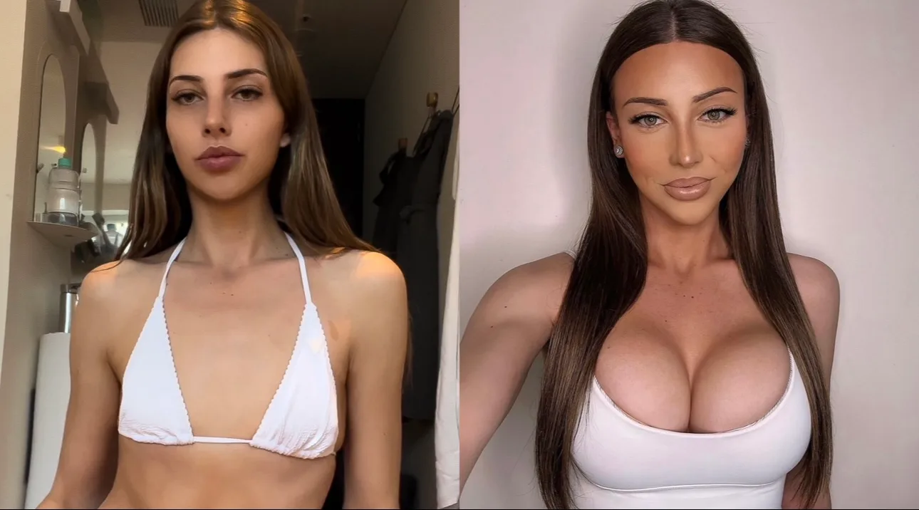Blake Butler before and after plastic surgery